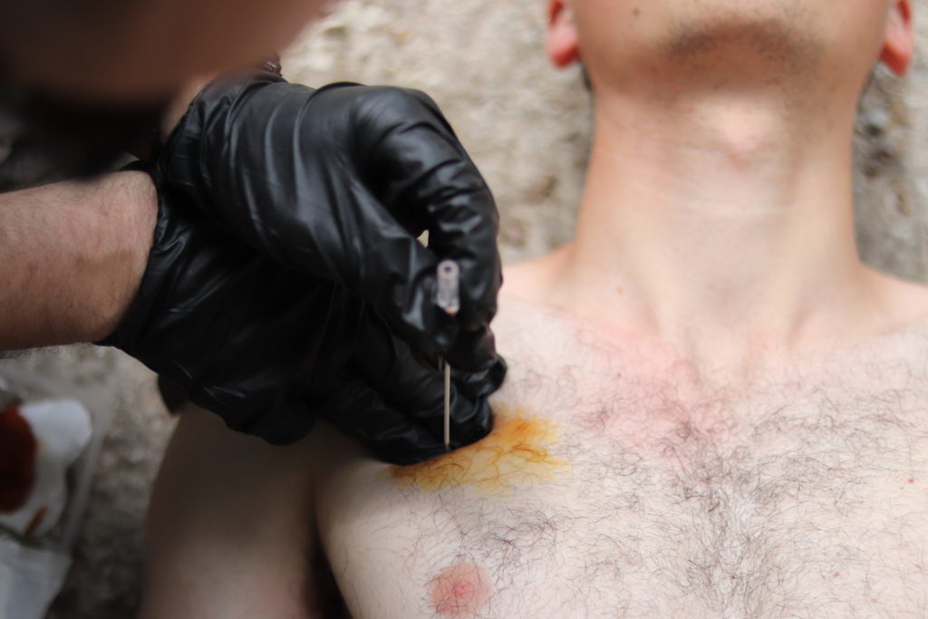 L’exsufflation à l’aiguille de décompression fait parti des gestes salvateurs.